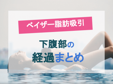 下腹部のベイザー脂肪吸引の経過をまとめてみました！