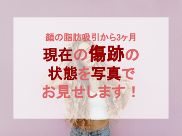 【顔の脂肪吸引から3ヶ月】現在の傷跡の状態を写真でお見せします！