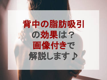 背中の脂肪吸引の効果は？画像付きで解説します♪